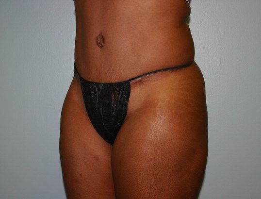 Tummy Tuck Before & After