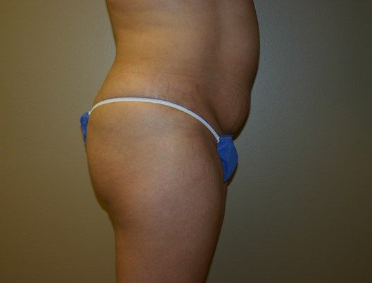 Tummy Tuck Before & After