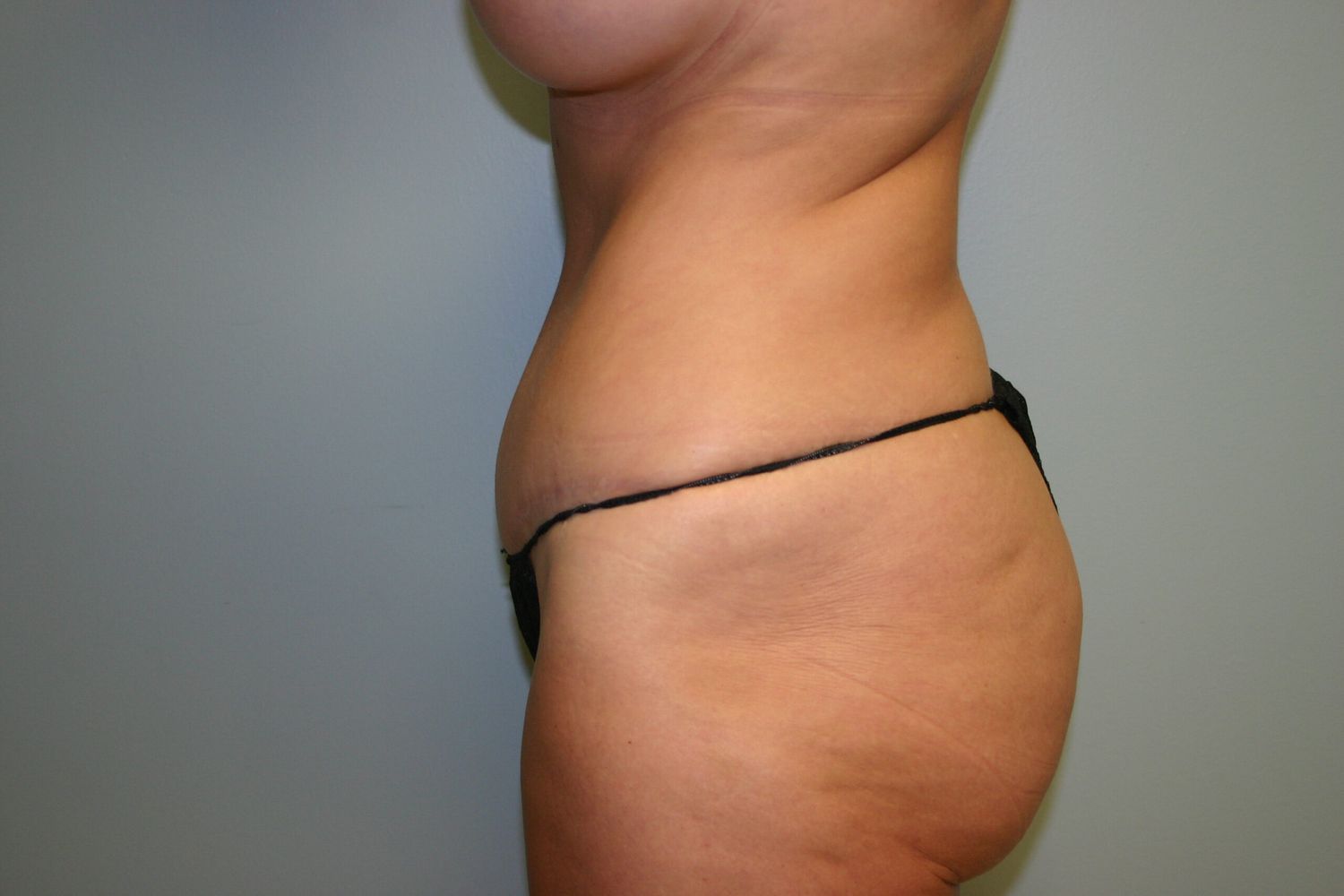 Tummy Tuck Before & After