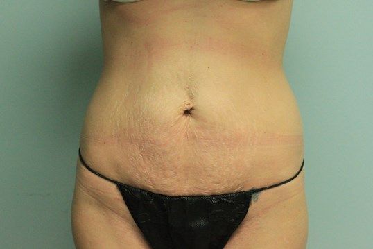 Tummy Tuck Before & After
