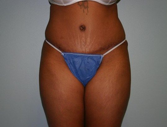 Tummy Tuck Before & After