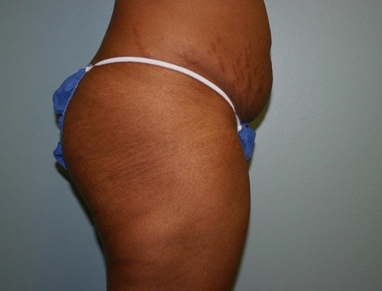 Tummy Tuck Before & After