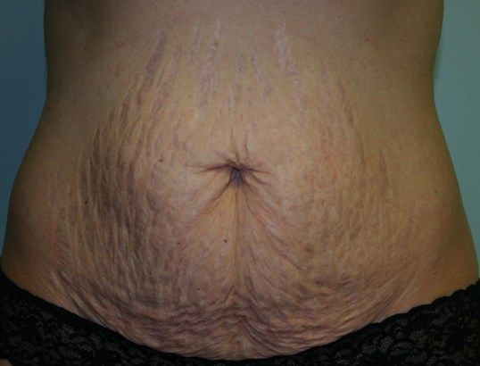 Tummy Tuck Before & After