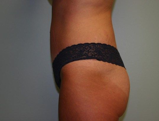 Tummy Tuck Before & After