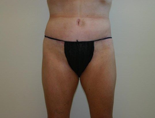 Tummy Tuck Before & After