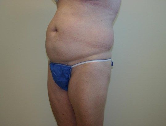 Tummy Tuck Before & After