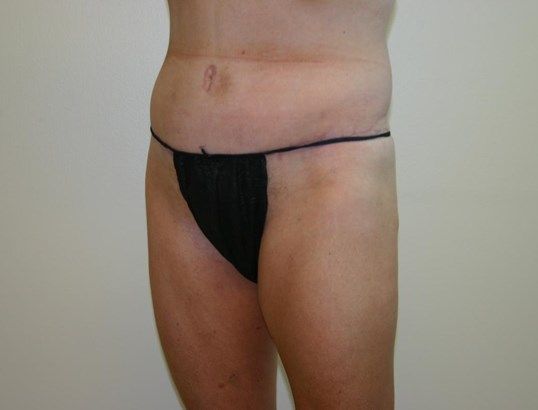 Tummy Tuck Before & After