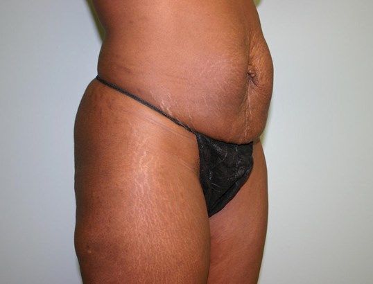Tummy Tuck Before & After