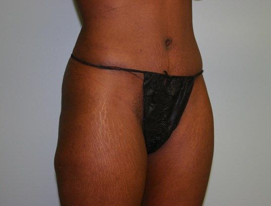 Tummy Tuck Before & After