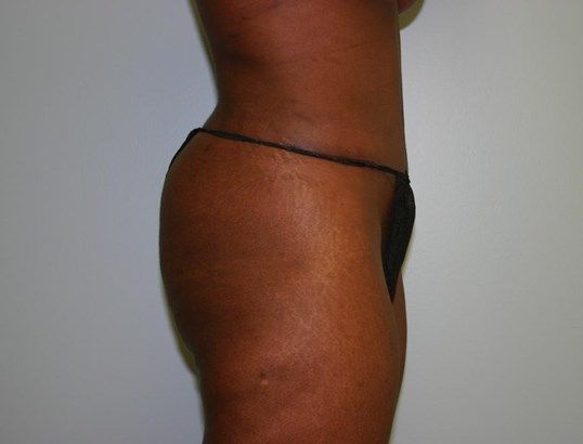 Tummy Tuck Before & After