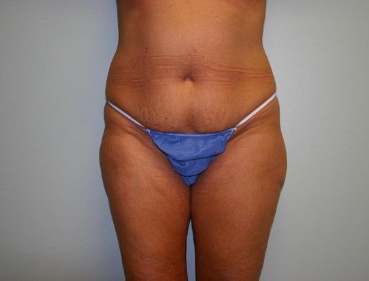 Tummy Tuck Before & After