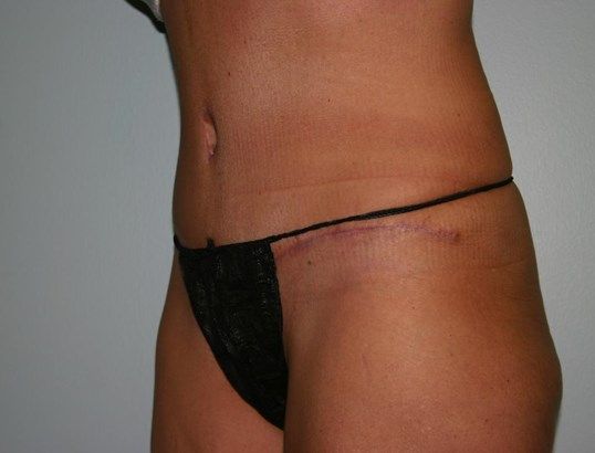 Tummy Tuck Before & After