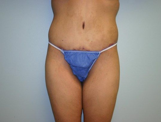 Tummy Tuck Before & After