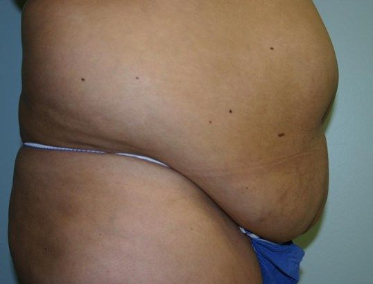 Tummy Tuck Before & After