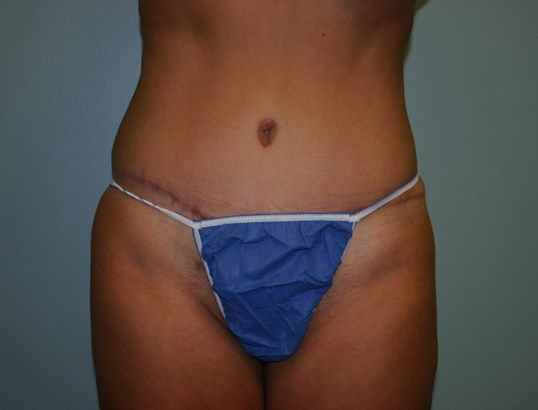 Tummy Tuck Before & After