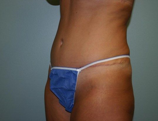 Tummy Tuck Before & After