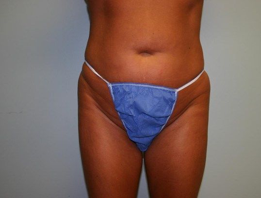 Tummy Tuck Before & After