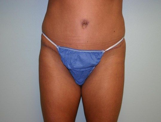 Tummy Tuck Before & After