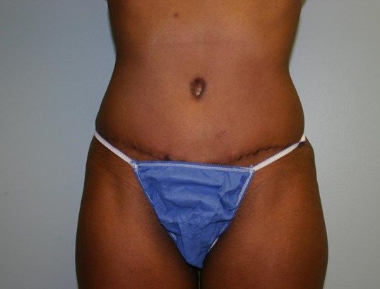 Tummy Tuck Before & After