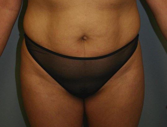Tummy Tuck Before & After