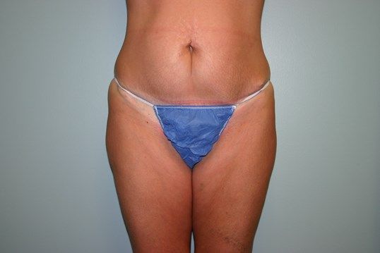 Tummy Tuck Before & After