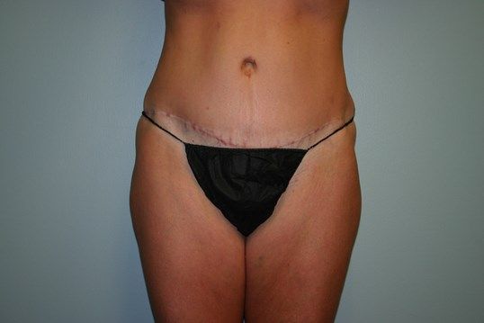 Tummy Tuck Before & After