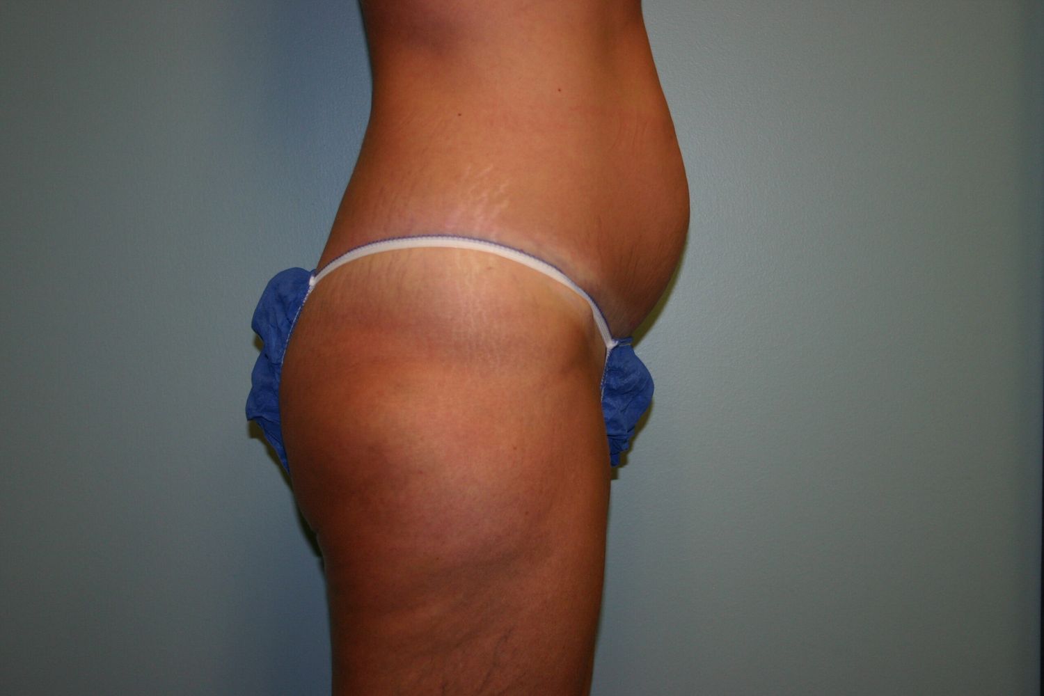 Tummy Tuck Before & After