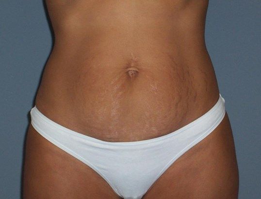 Tummy Tuck Before & After