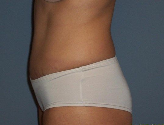 Tummy Tuck Before & After