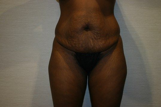 Tummy Tuck Before & After
