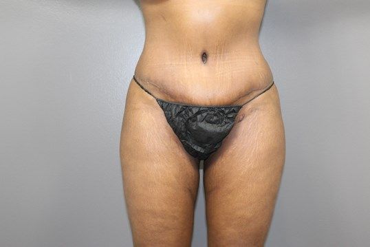 Tummy Tuck Before & After