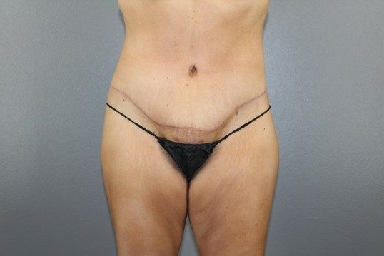 Tummy Tuck Before & After