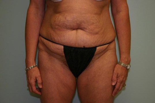 Tummy Tuck Before & After