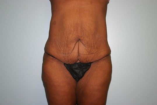 Tummy Tuck Before & After