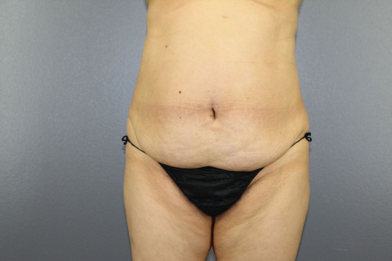 Tummy Tuck Before & After