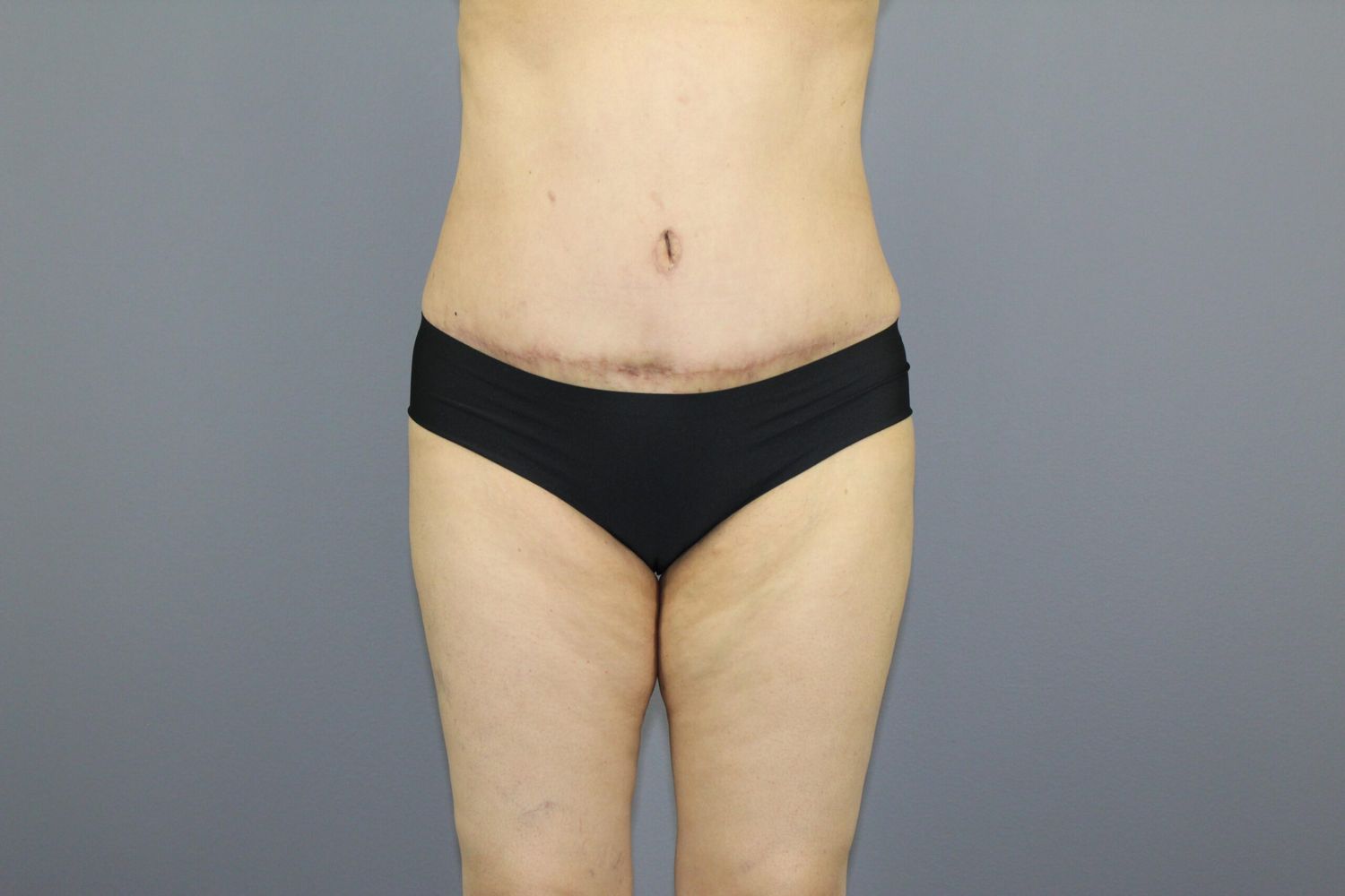 Tummy Tuck Before & After