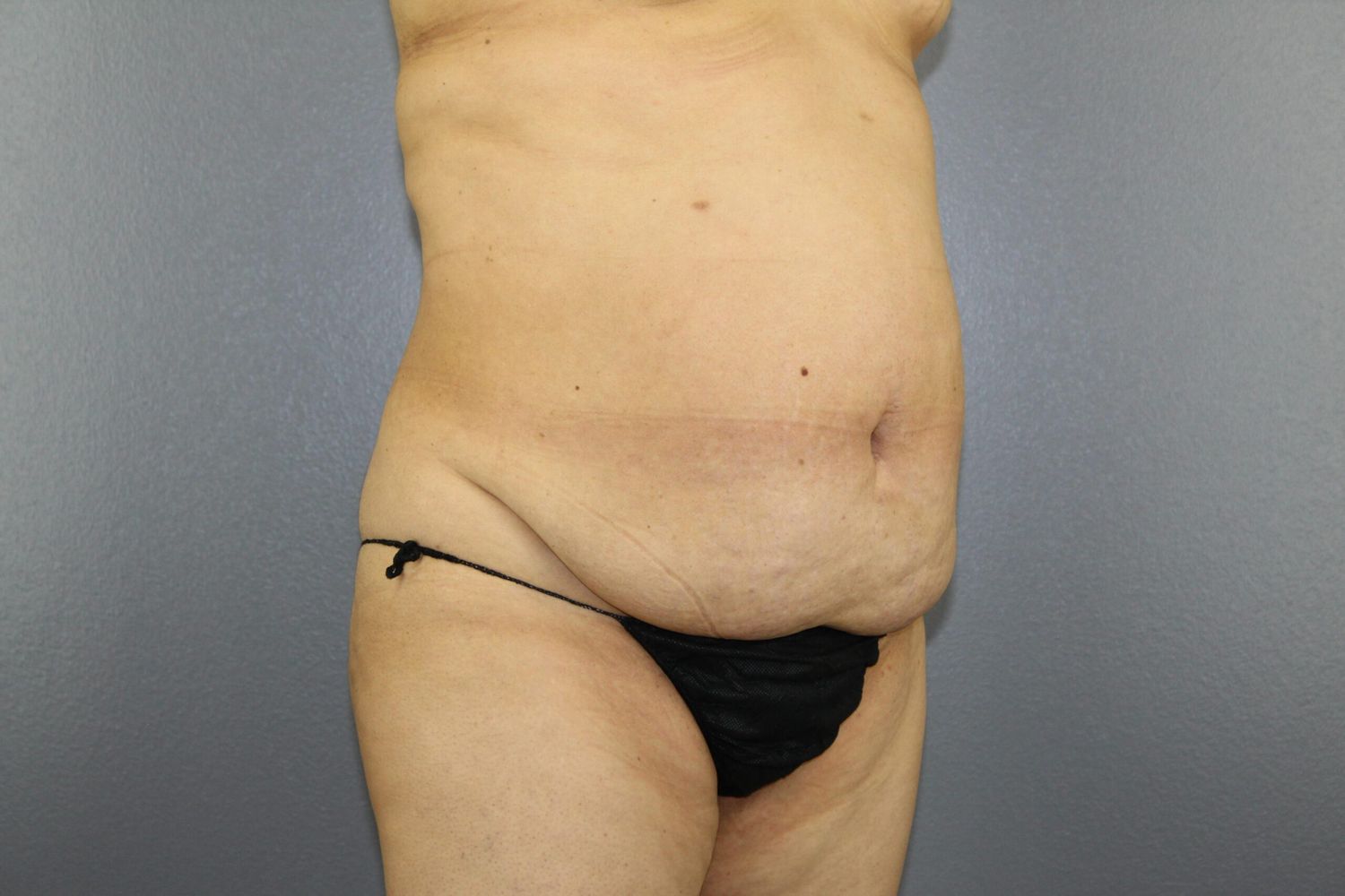 Tummy Tuck Before & After