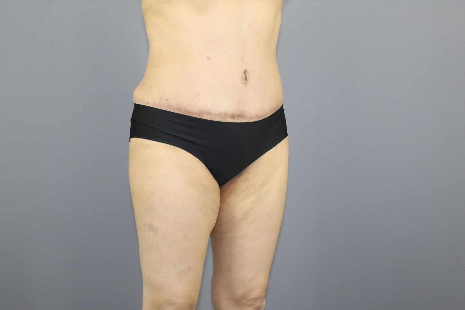 Tummy Tuck Before & After