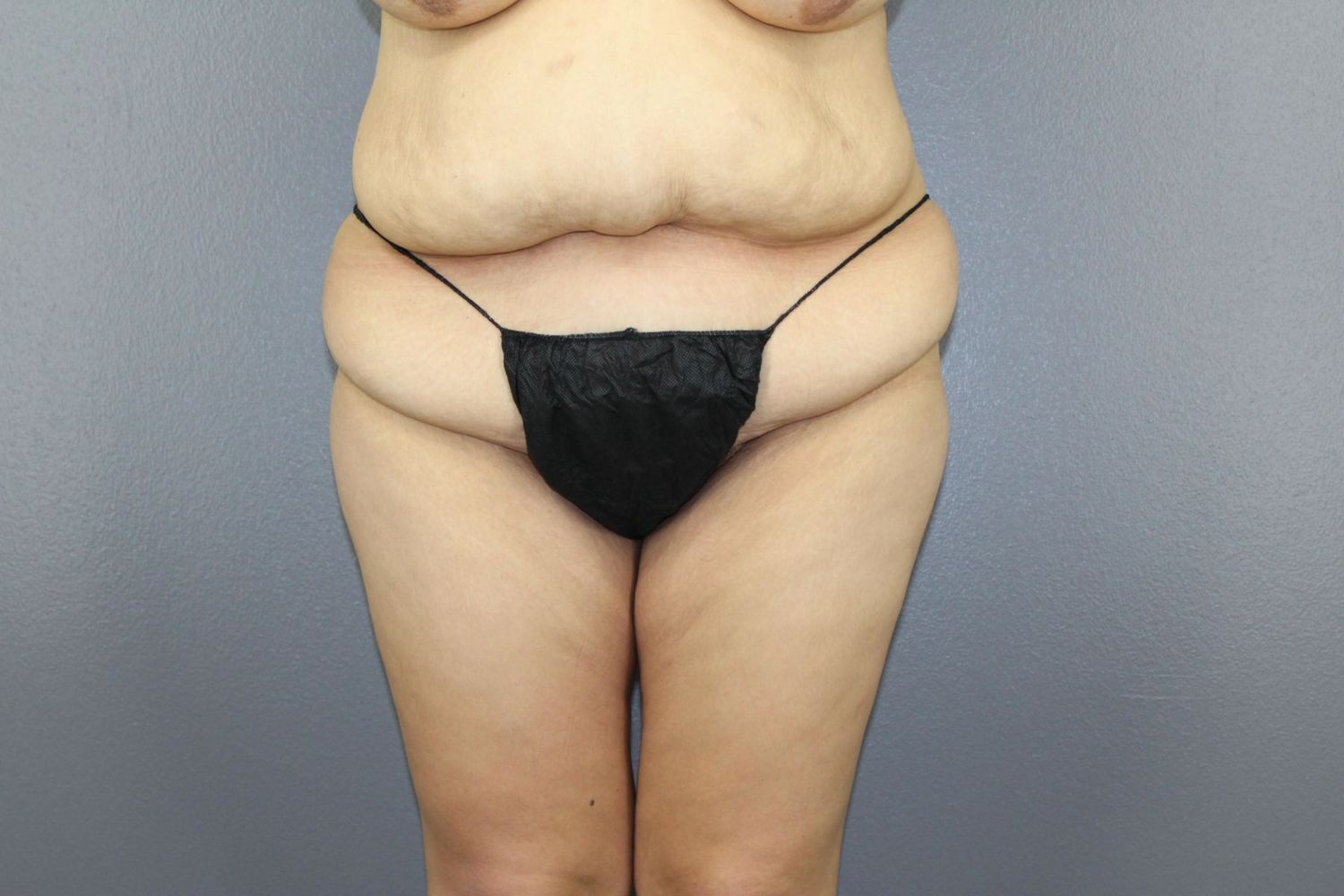 Tummy Tuck Before & After