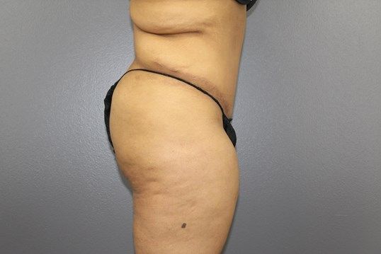 Tummy Tuck Before & After