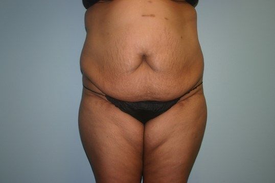 Tummy Tuck Before & After