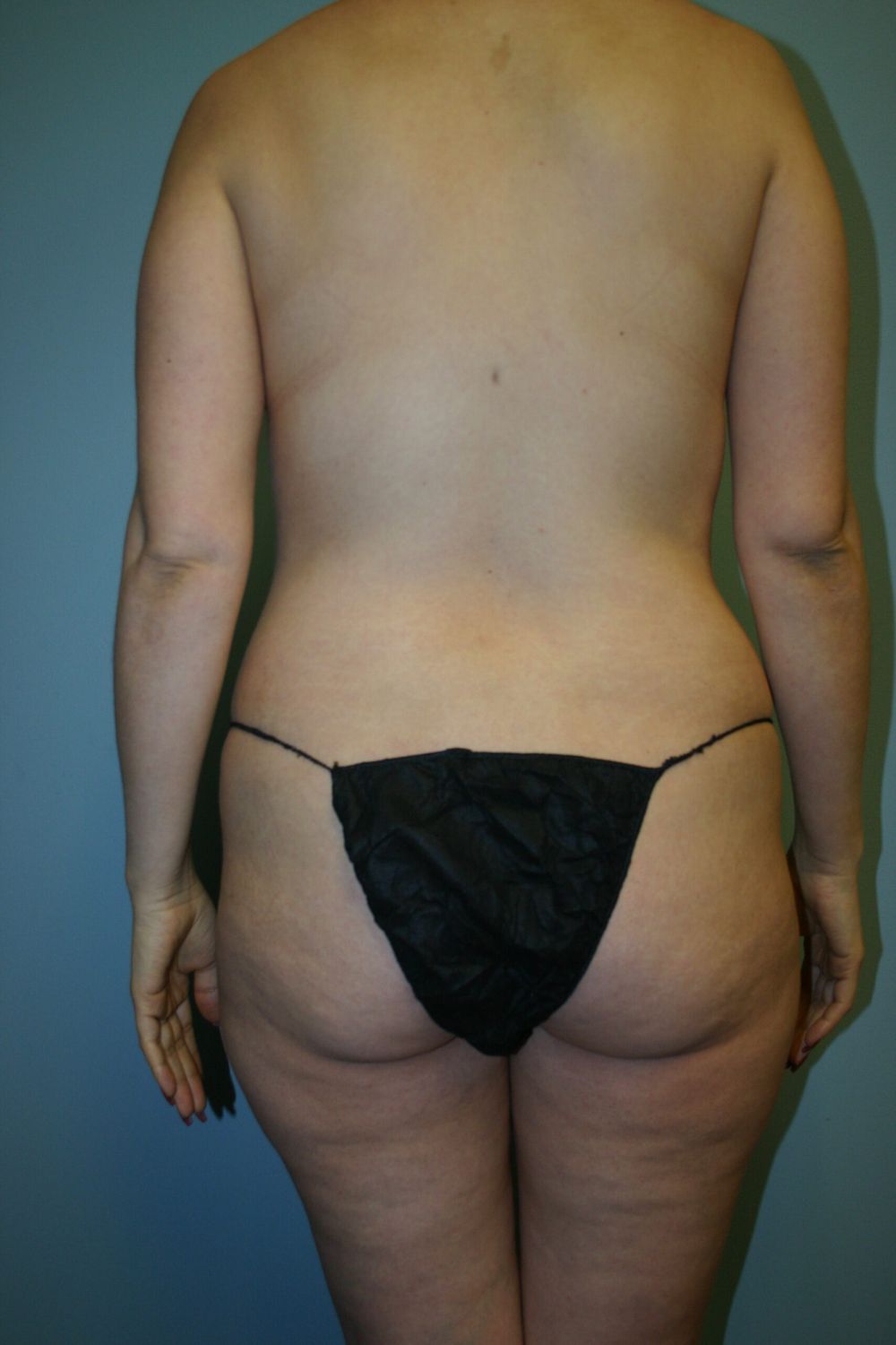 Body Contouring Before & After