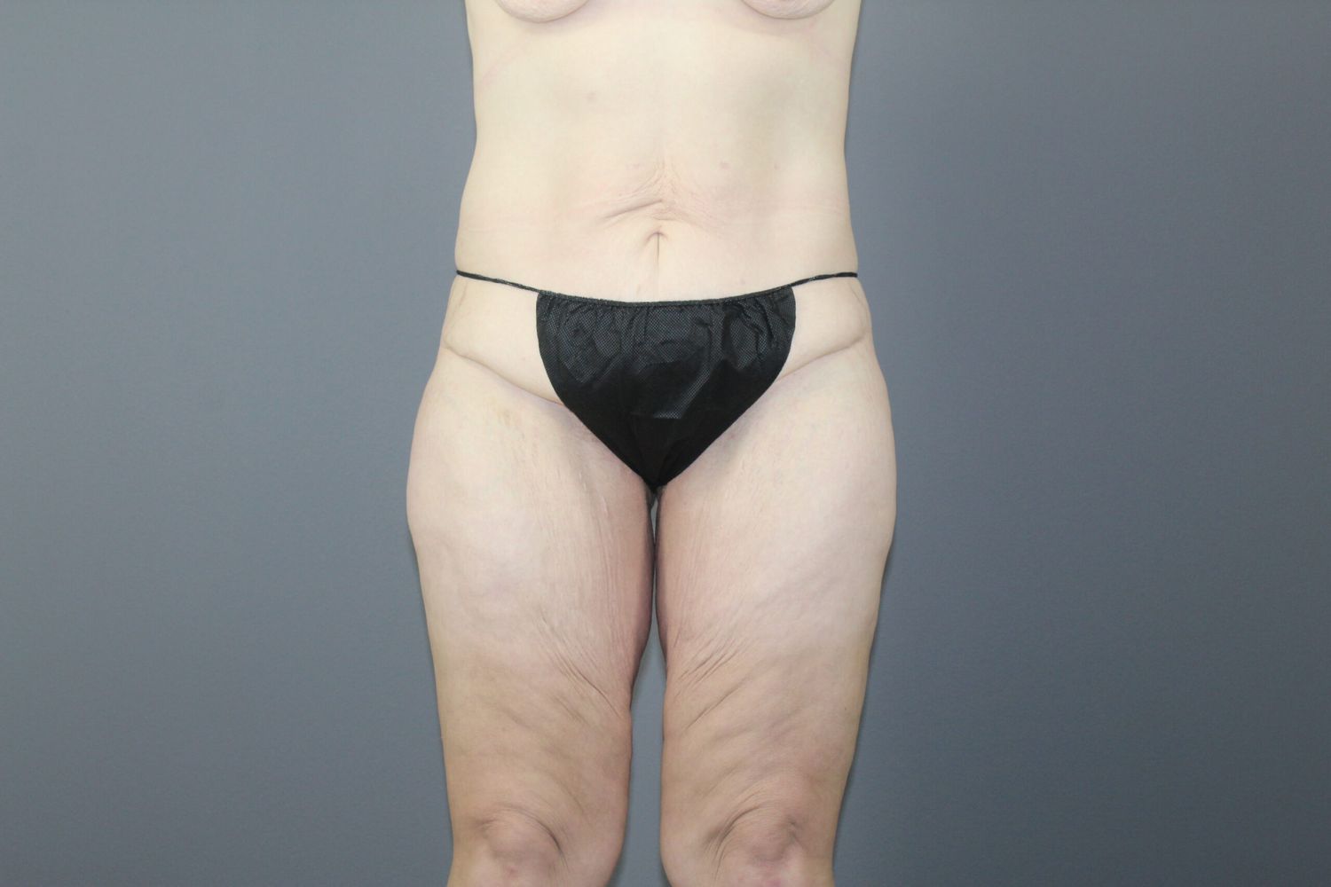 Body Contouring Before & After