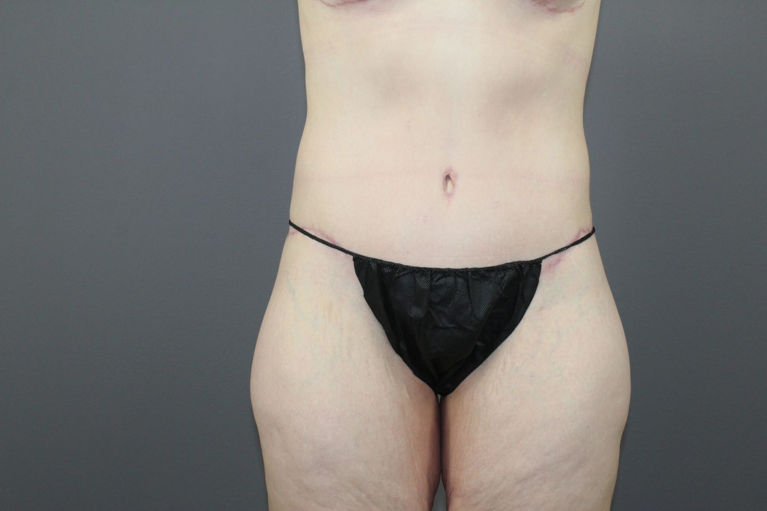 Body Contouring Before & After