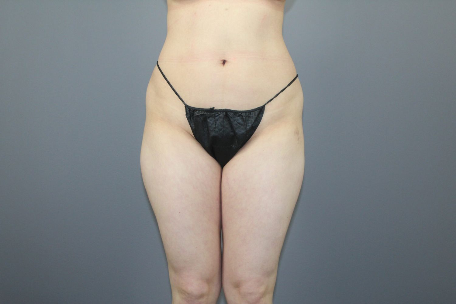 Body Contouring Before & After