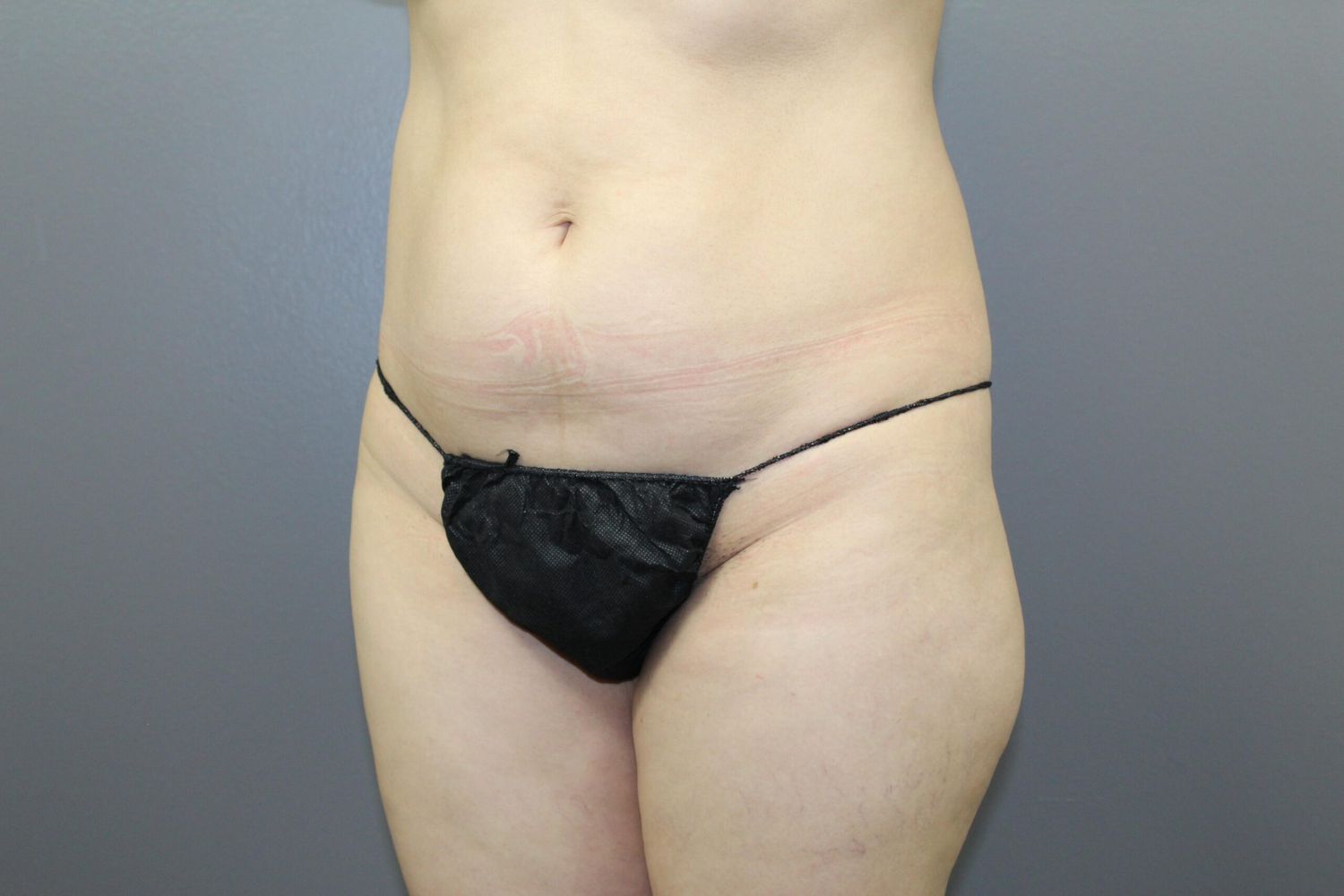 Body Contouring Before & After