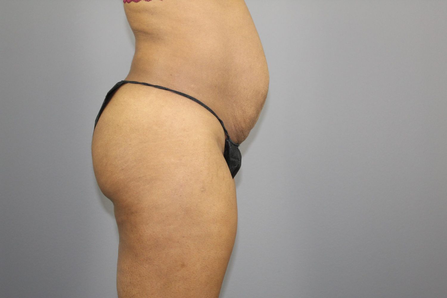 Body Contouring Before & After