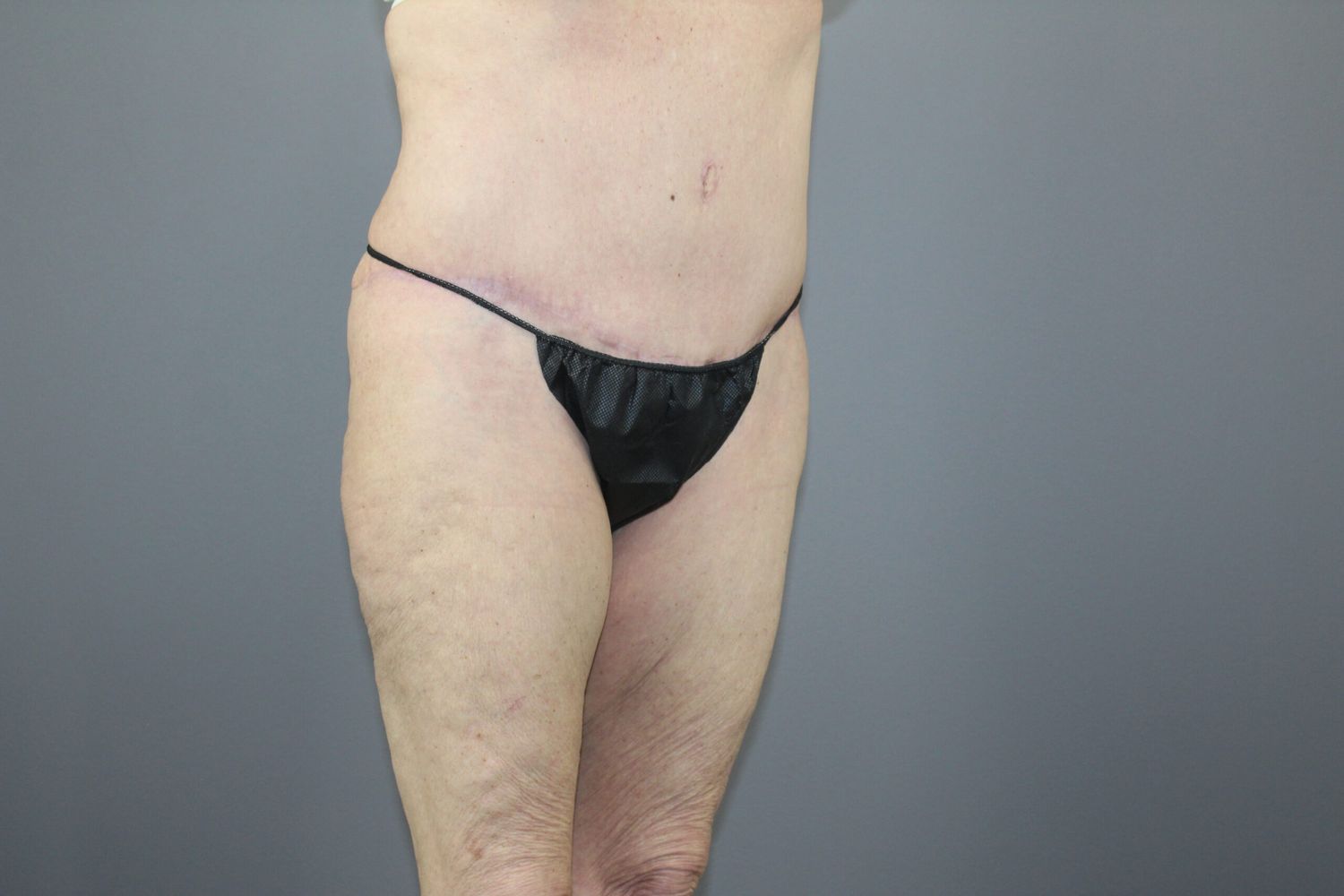 Body Contouring Before & After