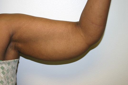 Body Contouring Before & After