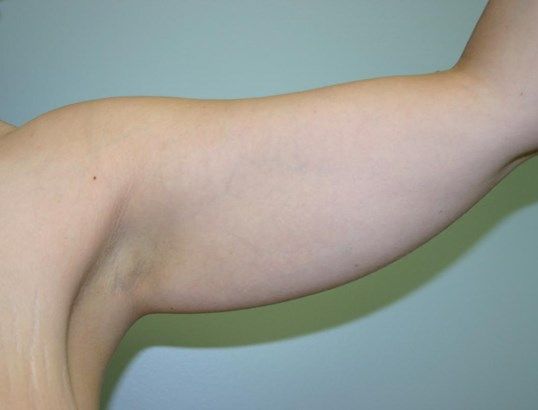 Body Contouring Before & After